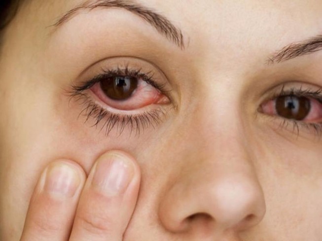 Cảnh báo việc đắp lá trầu chữa bệnh đau mắt đỏ