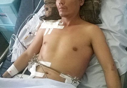 Cứu sống bệnh nhân rơi trên cao, bị bê tông đè