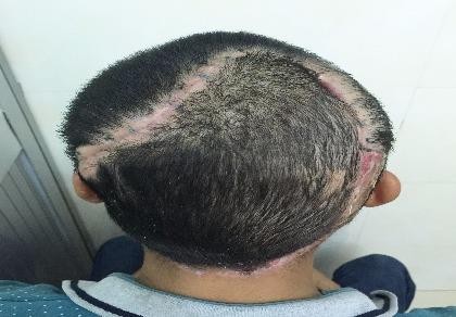 Cấy tóc cho bệnh nhân bị… lộ xương sọ
