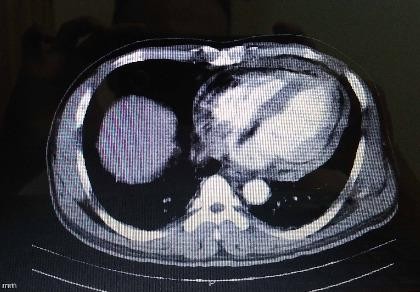 Cứu tài xế xe ôm bị tràn máu màng tim do dao đâm