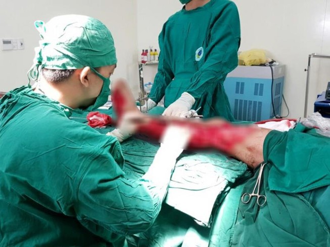 Cứu bệnh nhân nát chân trái vì bị máy cuốn