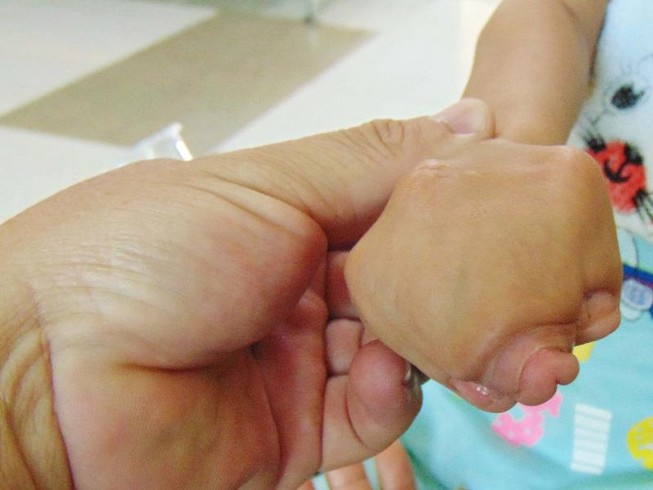 Mổ tách bàn tay 'dính chùm' cho bé gái 8 tuổi