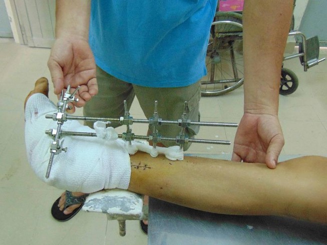 3 lần phẫu thuật cứu bàn chân dập nát do xe nâng cán