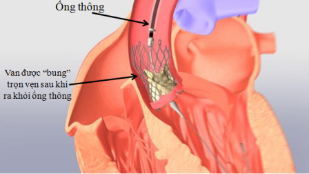 Thay van tim qua ống thông giúp rút ngắn thời gian điều trị