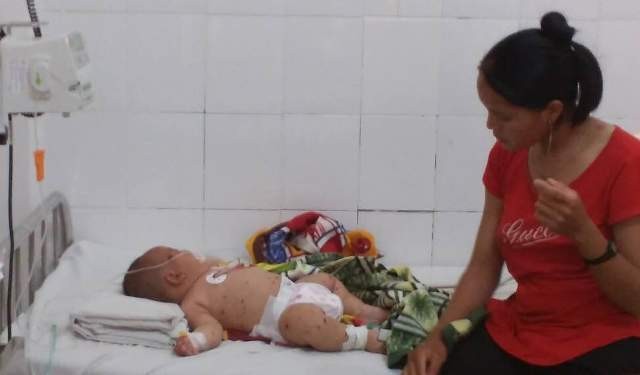 Đắk Lắk: Bé trai năm tháng tuổi nghi nhiễm não mô cầu