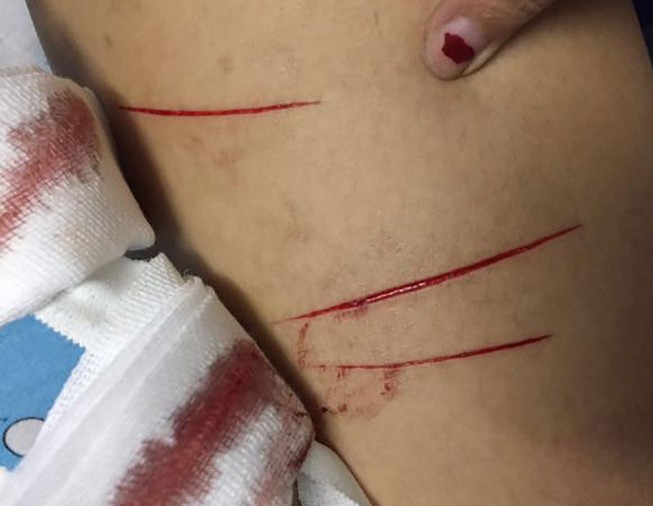 Nữ sinh bị rạch đùi phải uống phơi nhiễm HIV