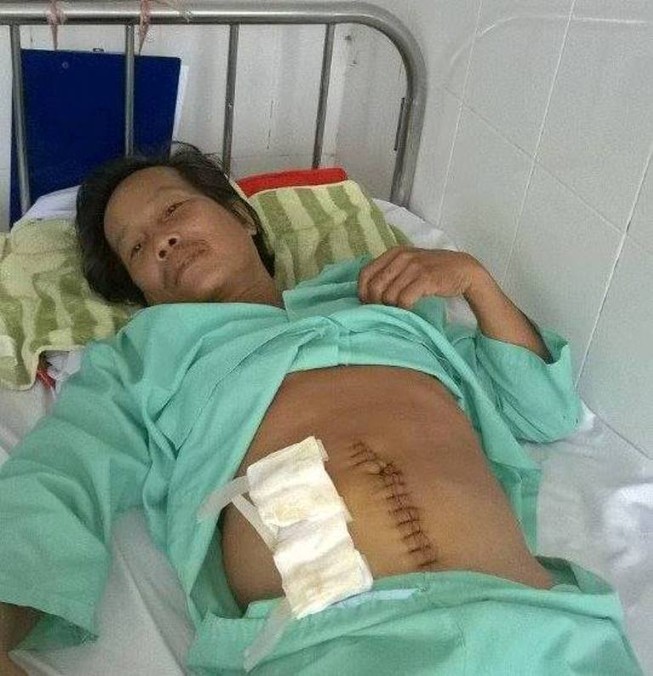 Bị thủng ruột già vì vừa ăn vừa... ngậm tăm