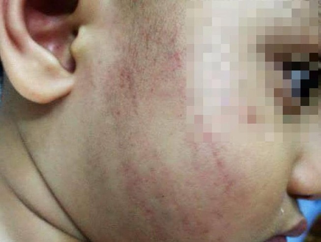 Buộc thôi việc cô giáo mầm non tát trẻ bầm mặt