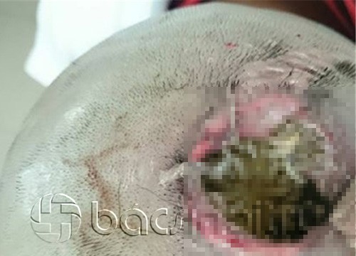 Hi hữu cứu sống bệnh nhân có giòi trong não