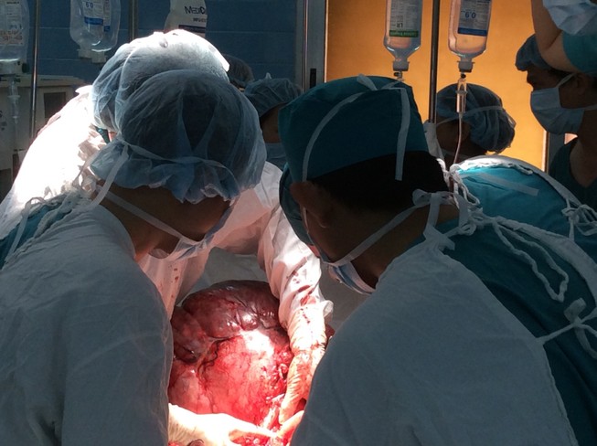 Cắt khối bướu tử cung nặng 26 kg