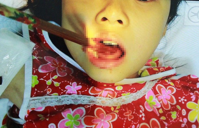 Hi hữu bé gái bị đôi đũa đâm thủng lưỡi
