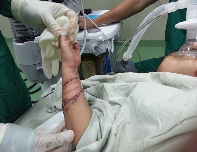 Bé trai bốn tuổi bị cá sấu cắn nát tay