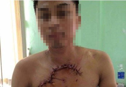 Cứu sống bệnh nhân bị tai nạn, tim phổi lộ ra ngoài thành ngực