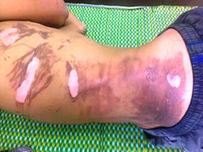 Thanh niên bị bỏng vì ngậm xăng phun lửa