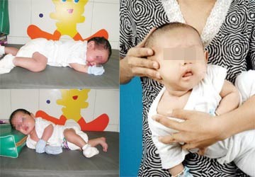 Trẻ vẹo cổ, nằm sao cho đúng?