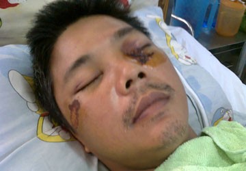 Bảo vệ dân phố đánh người dập não