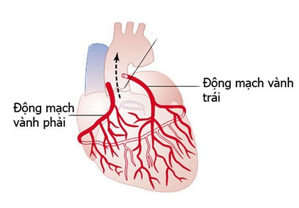 Cứu sống nhiều ca mạch vành cấp nặng cấp cứu