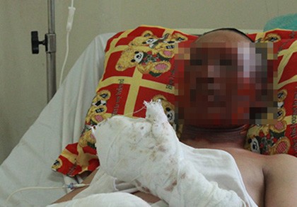 Nổ lò luyện thép, hai công nhân bỏng nặng