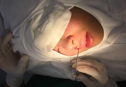 Cảnh giác với nâng mũi không cần dao kéo