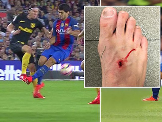 Suarez chơi xấu khiến chân đối thủ… lủng lỗ