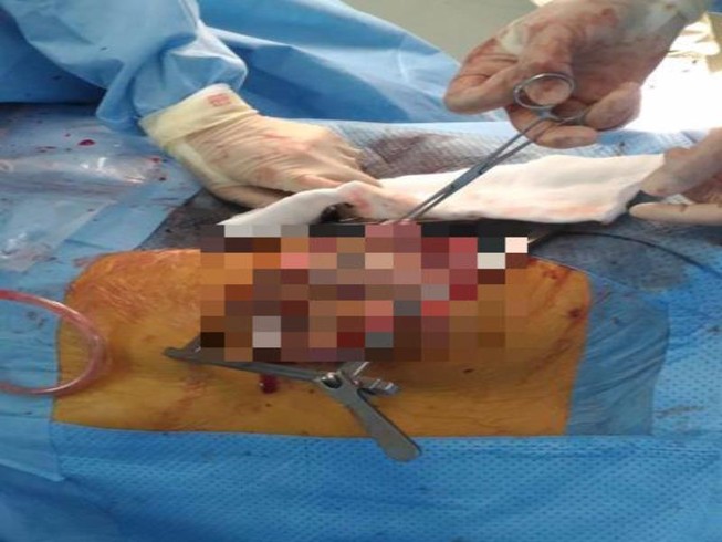 Cắt bỏ khối u gần 7 kg trong lồng ngực bệnh nhân
