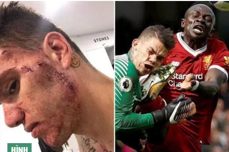 Sao Man City ‘khoe’ ảnh… nát mặt sau va chạm kinh hoàng