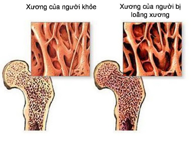 Người cao tuổi và bệnh xương khớp