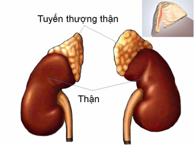 Bệnh nhi 4 ngày tuổi bị u tuyến thượng thận