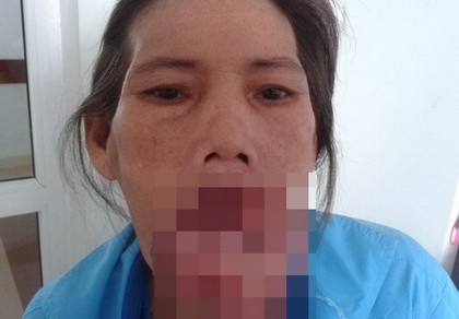 Phẫu thuật loại bỏ khối u 'khổng lồ' ở môi dưới