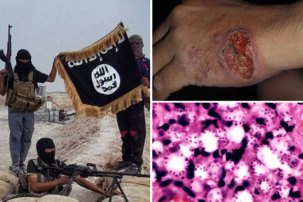 Virus ‘ăn thịt người’ tấn công khủng bố IS