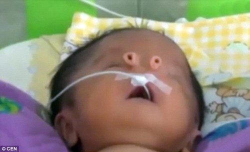Kỳ lạ em bé sinh ra với hai cái mũi