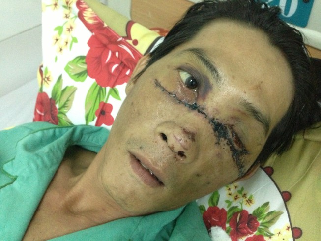 Gãy đôi xương mặt, múc bỏ nhãn cầu trái vì nổ bánh 'xe rùa'