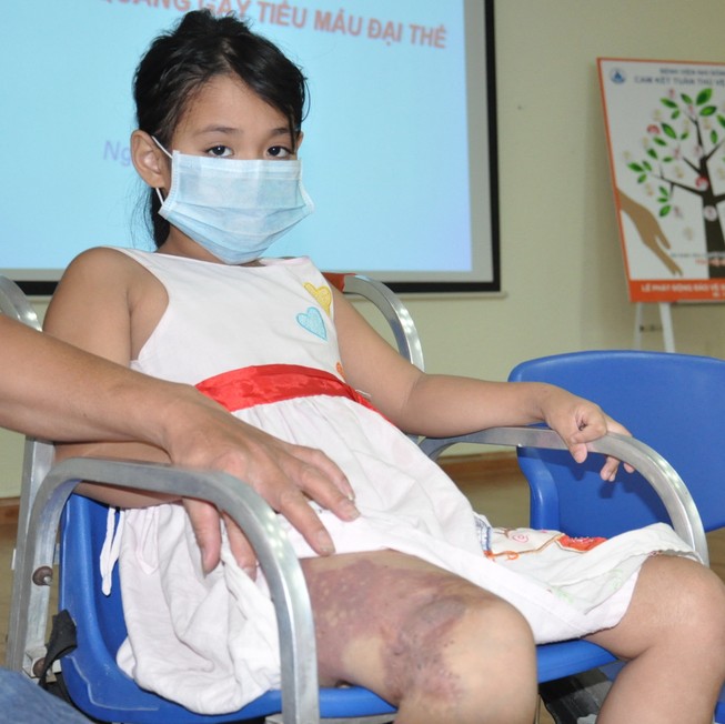 Hi hữu bệnh nhi bị chảy máu vào bàng quang