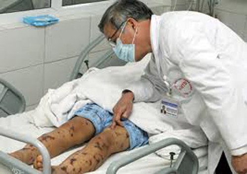 Cục Y tế dự phòng cảnh báo bệnh viêm não mô cầu