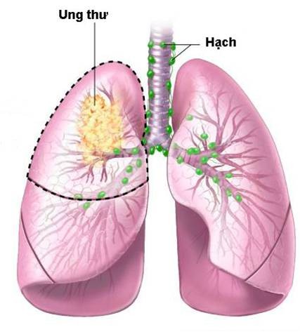 Ung thư phổi không phải là bản án tử!