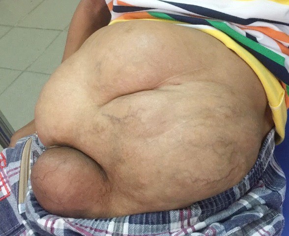 Khối bướu 4,3 kg biến bé trai đi tiểu giống… bé gái