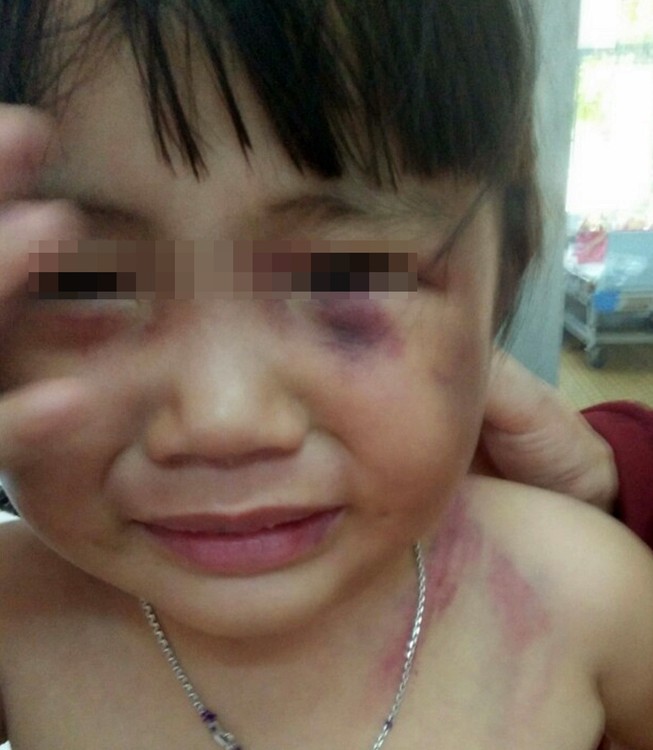 Bé gái ba tuổi bị cha dượng đánh dã man để ‘trả thù’!