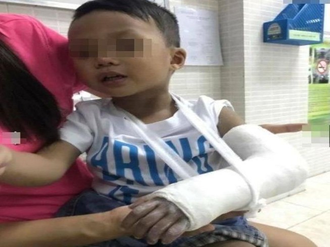 Thực hư vụ “cô giáo đập bàn vô tình làm gãy tay trẻ”