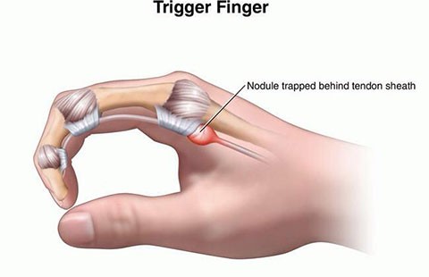 Bệnh viêm bao gân gấp ngón tay