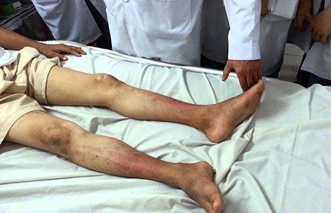Trị bệnh cho chân bằng sóng cao tần