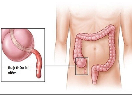 Cấp cứu thành công ngư dân đau ruột thừa trên biển
