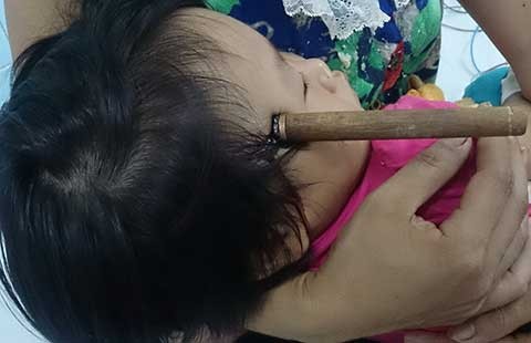Cứu cháu bé bị dao găm vào não