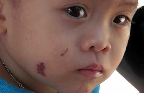 Bé trai đầy thương tích sau hai ngày đi học