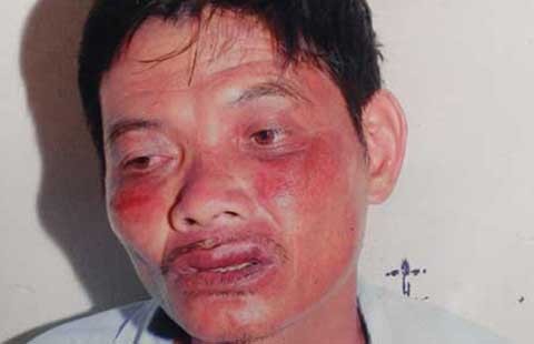 Vụ nhập viện sau khi đến CA xã: Điều chuyển CA liên quan