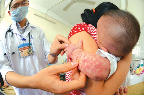 Khống chế hoàn toàn dịch sởi ở Việt Nam