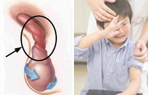 Cảnh giác cao độ với xoắn tinh hoàn
