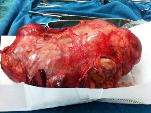 Cắt khối u thận ‘khủng’ 2,9 kg