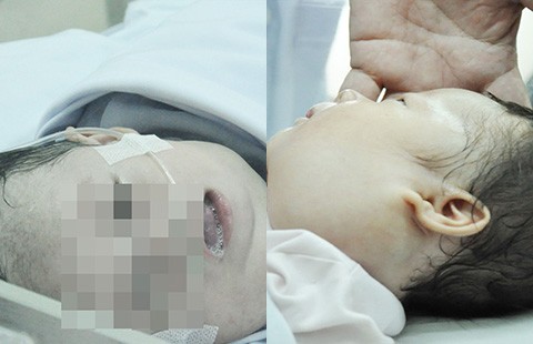 Xót xa 2 bé sơ sinh mắc bệnh hiểm nghèo làm biến dạng khuôn mặt
