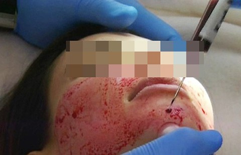 Rủ nhau làm đẹp bằng... máu