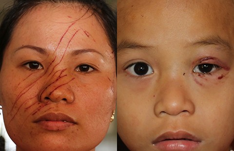 Hai mẹ con bị hàng xóm rạch nát mặt